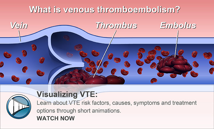 Understanding VTE: Learn about VTE through this short animation. WATCH NOW